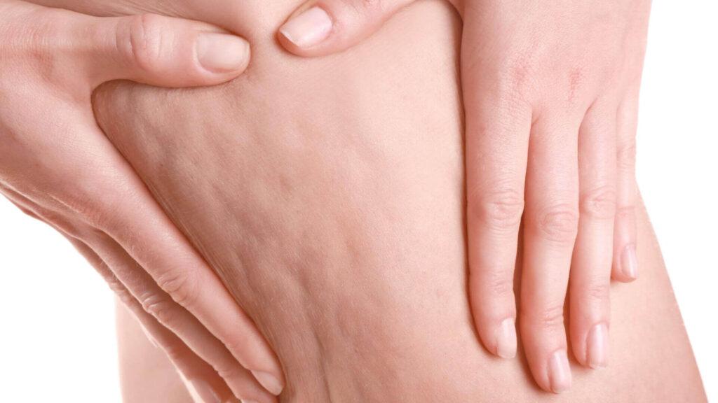 Cellulite Symptoms